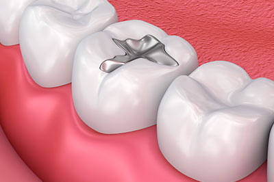 The image shows a close-up of a dental implant embedded in a tooth with surrounding teeth and gum tissue.