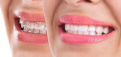 An image of a smiling woman with a close-up view focusing on her teeth and lips, set against a blurred background.