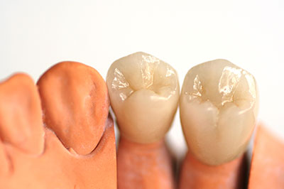 The image shows a set of artificial teeth and gums, likely used for dental implants or prosthetics, with one tooth missing a crown.