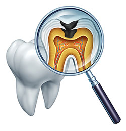 An illustration of a magnified human tooth with a visible pulp chamber and root, set against a white background.