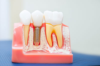 The image shows a dental model with multiple teeth and a screw, likely used for educational or demonstrative purposes.