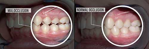 The image shows a before-and-after comparison of a dental procedure, with the  before  side displaying a mouth with missing teeth and the  after  side showing a mouth with restored teeth.