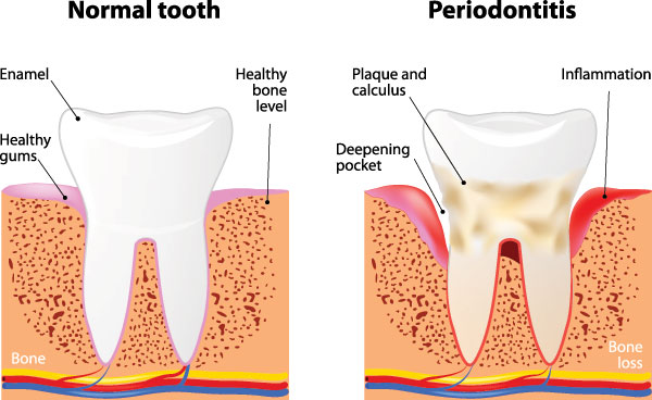 The image is a medical illustration showing the normal tooth structure and two stages of periodontitis with annotations indicating bone loss, healthy gum pocket, and inflammation.