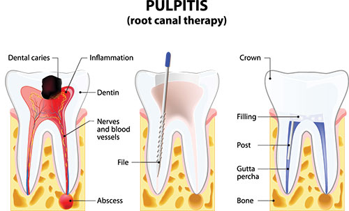 The image depicts a diagrammatic illustration of the pulpitis of a tooth, showing the affected area with annotations explaining the process.