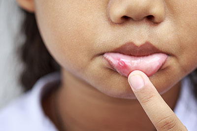 A young child with a pimple on their face, holding it between two fingers.