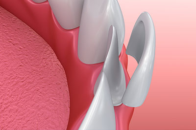 The image displays a close-up of a dental implant with a visible screw, set against a soft pink background that resembles gum tissue.