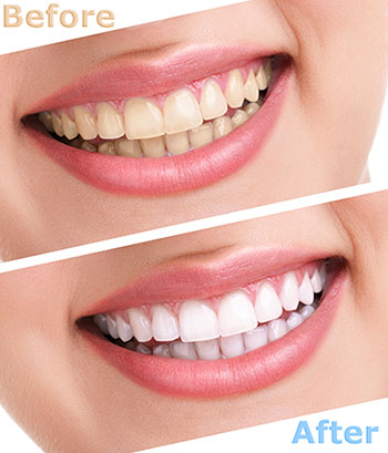 Before and after image of a smile enhancement procedure, showcasing the transformation from a natural smile to a brighter, straighter, and more polished set of teeth.