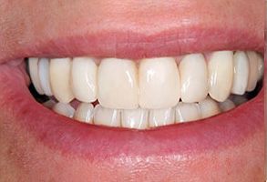 A close-up image of a person s smiling mouth, showcasing straight white teeth.