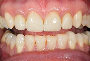 The image shows a close-up of a person s teeth with a focus on the bottom row, where there is discoloration and decay.