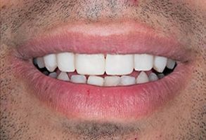 The image is a close-up of a person s smiling face, showing teeth and lips.