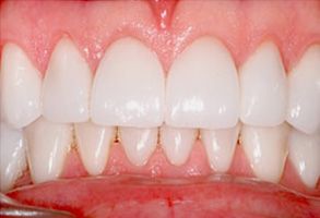 The image shows a close-up of human teeth, focusing on the upper front teeth and gums.