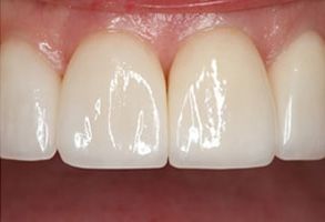 The image shows a close-up view of a person s teeth and gums, focusing on the lower front teeth.