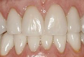 The image shows a close-up of a person s teeth with a focus on the dental implants, which are white and appear to be well-maintained.