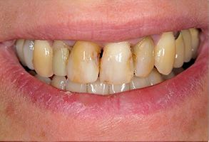 The image shows a close-up of a human mouth with teeth that appear to have been treated, possibly for staining or discoloration.