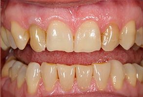 The image is a close-up of a person s teeth with an overbite, showcasing a set of yellowed teeth in need of dental care.