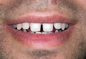 The image shows a close-up of a person s face with a wide smile, revealing teeth and gums. A small amount of facial hair is visible around the mouth area.