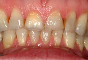The image shows a close-up of a person s teeth, where the upper teeth are yellowed and the lower teeth appear to be in better condition.