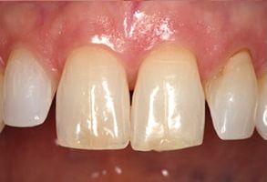 Image of a close-up view of a person s mouth showcasing a set of teeth with visible signs of discoloration or staining.