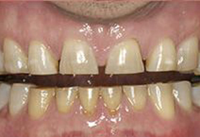 The image displays a close-up of an individual s teeth with visible staining and discoloration, particularly around the gum line.
