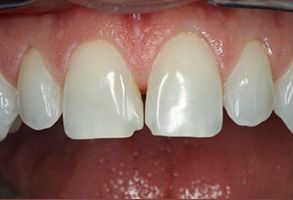 Alt text  Close-up of a person s mouth with visible teeth and gums, showcasing dental work.